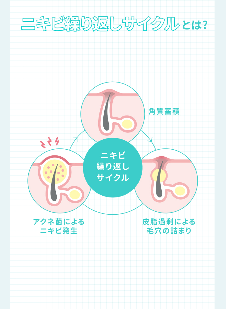 ニキビ繰り返しサイクルとは? 角質蓄積 アクネ菌によるニキビ発生 皮脂過剰による毛穴の詰まり